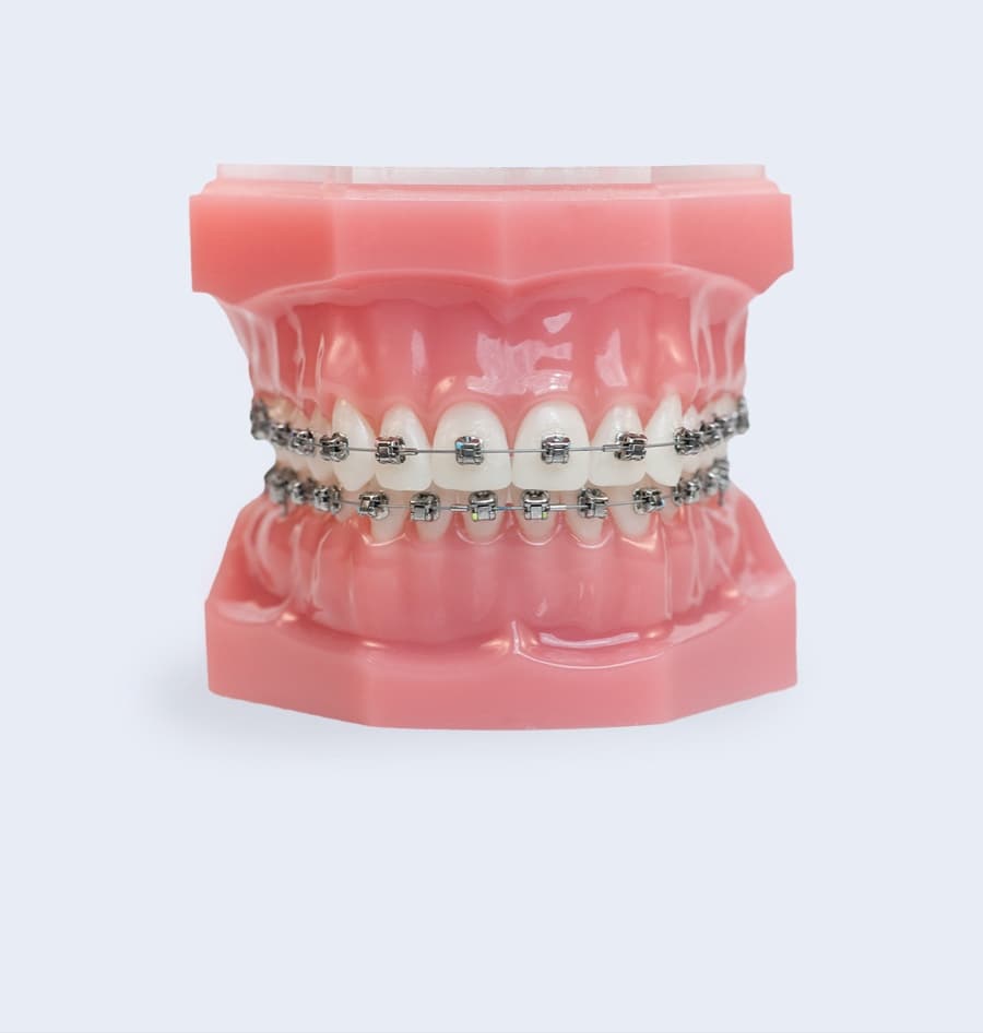 metal braces photo